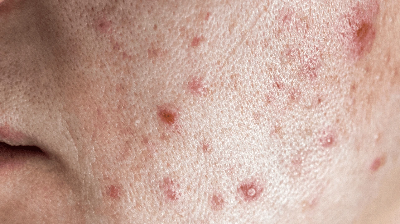 Acne Scars